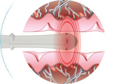 EMfemme 360 feminine health treatment Amsterdam - illustration of the applicator treating Illustration of the applicator treating the tissue for EMfemme 360 feminine health treatment in Amsterdam
