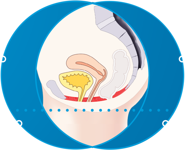 EMfemme 360 feminine health treatment Amsterdam - diagram of the pelvic floor during Diagram of the pelvic floor during treatment for EMfemme 360 feminine health treatment in Amsterdam
